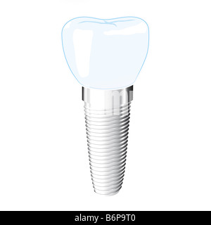 Impianto dentale Foto Stock