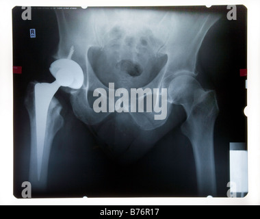 X-RAY della Pelvi maschile con anca artificiale Foto Stock