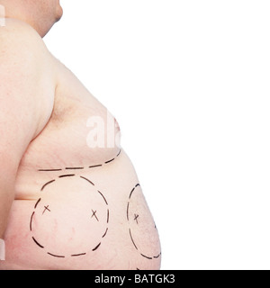 La liposuzione. Aree di grasso in eccesso segnato su un addome di mezza età Foto Stock