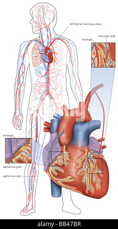 Schema della doppia chirurgia di bypass delle arterie coronariche. Foto Stock