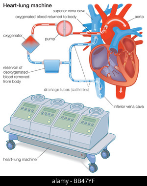 Una macchina cuore-polmone devia il sangue dal corpo di un ossigenatore, che rimuove la CO2, aggiunge O2, e riporta il sangue per il corpo Foto Stock