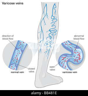 Schema illustrante le vene varicose Foto Stock