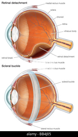 Schema di una fibbia sclerale, utilizzati per la riparazione di un distacco della retina. Foto Stock