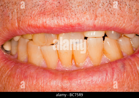 Una chiusura di un anziano mans giallo denti macchiati Foto Stock