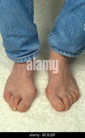 In prossimità dei piedi con Callosità e alluce valgo Foto Stock
