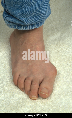 Close up di un piede con un bunion Foto Stock