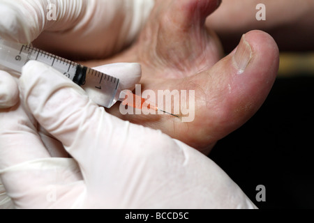 Iniezione di anestetico locale in un alluce prima di resezione a cuneo un intervento chirurgico per un incarniti toenail Foto Stock