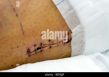 Post-operative foto di un paziente dopo un mountain bike incidente medici necessari per avvitare una piastra di titanio nella sua gamba sinistra Foto Stock