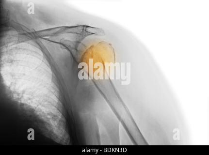 X-ray della spalla di un 81 anno vecchia donna con osteoporosi che mostra una frattura della testa dell'omero Foto Stock