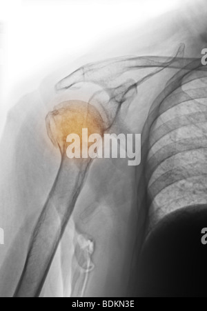 X-ray della spalla di un 81 anno vecchia donna con osteoporosi che mostra una frattura della testa dell'omero Foto Stock