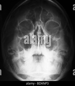 Cranio x-ray di 17 anni, maschio Foto Stock