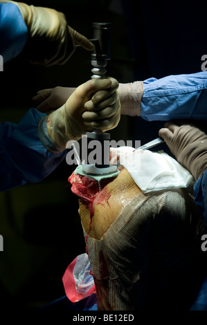 Un paziente subisce la chirurgia di sostituzione del ginocchio a West Midlands ospedale, dopo aver diagnosticato con danni irreparabili Foto Stock