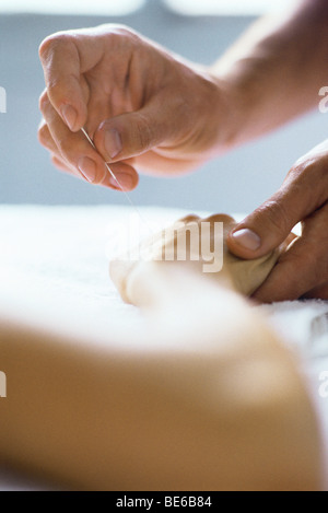 Ago di agopuntura essendo inserita nella mano del paziente Foto Stock