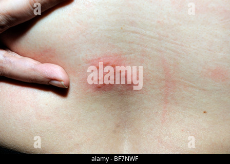 Un patch di herpes zoster rash. Vescicole. Herpes zoster. Foto Stock