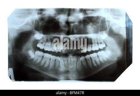 Ritratto di close-up di denti con bretelle dentali e elastici bocca piena  Foto stock - Alamy