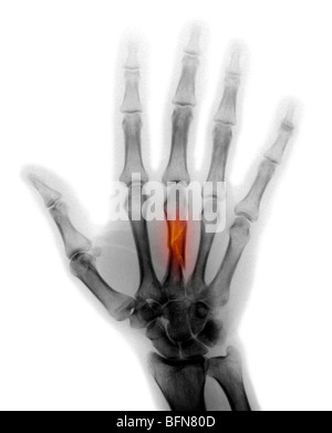 X-ray della mano che mostra una frattura del metacarpale medio di un uomo di 50 anni Foto Stock