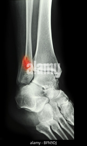 Raggi X che mostra una caviglia frattura in prossimita' di 49 anno vecchia donna Foto Stock