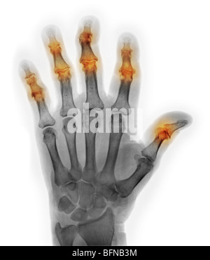 Mano x-ray di 85 anno vecchio con artrite degenerativa Foto Stock