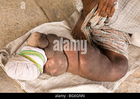 Bloated la gamba di un uomo indiano che soffrono di Elephantiasis. Foto Stock