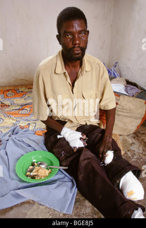 Un residente in un lebbrosario a Luanda, in Angola. Egli è gravemente colpiti dalla lebbra. Foto Stock