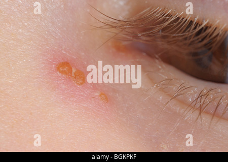 Close up fotografia di varicella di vescicole su una giovane ragazza Foto Stock