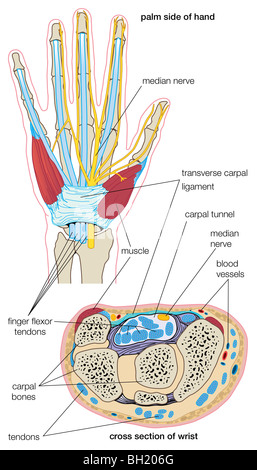 La sindrome del tunnel carpale Foto Stock