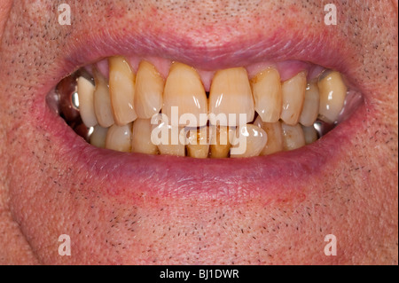 Un Modello rilasciato fino in prossimità di un anziano mans decadendo denti Foto Stock
