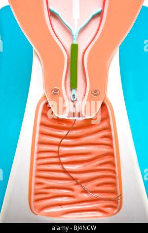 La Mirena sistema intrauterina, o ius (mostrato in un modello schematico), è un a lunga azione ormonale reversibile del dispositivo contraccettivo. Foto Stock