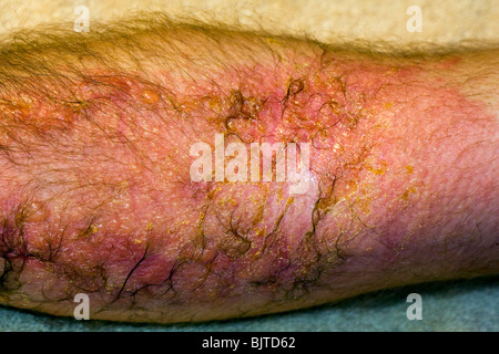 Gravi poison ivy rash/reazione. Foto Stock