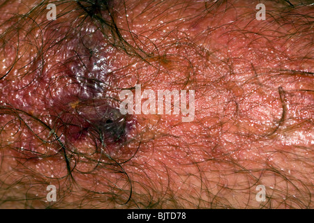 Gravi poison ivy rash/reazione. Foto Stock