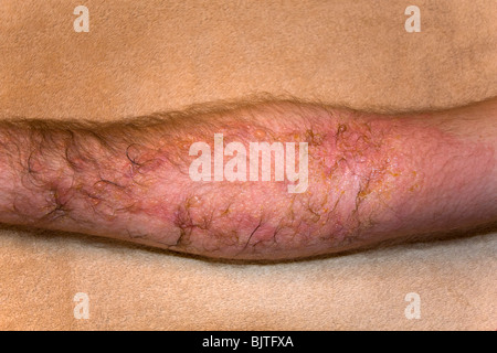 Gravi poison ivy rash/reazione. Foto Stock