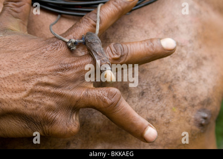 Un Huli tribesman nella Papua Nuova Guinea Highlands visualizza il suo dito mignolo, tagliato in un combattimento tribale Foto Stock