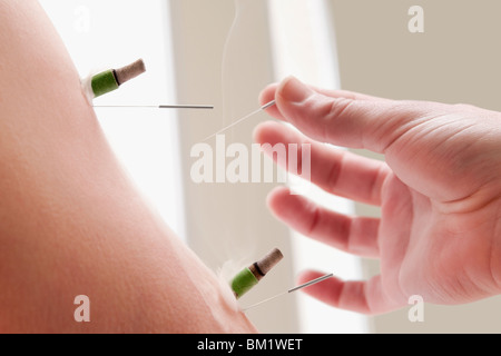 Agopuntore applicazione di aghi a base di erbe e di sigari su una persona del braccio Foto Stock