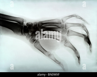 Dettaglio della mano xray immagine medica Foto Stock