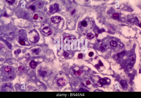 Micrografia luce di epatociti umani (cellule del fegato) infettati con il virus Ebola, la causa di Ebola febbre emorragica Foto Stock