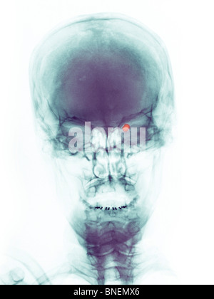 Cranio x-ray di una donna shot nell'occhio con una pistola di pellet. Foto Stock