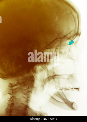 Cranio x-ray di una donna shot nell'occhio con una pistola di pellet. Foto Stock