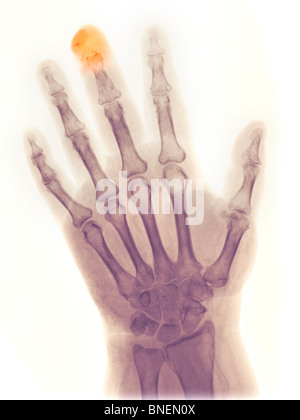 X-ray della mano che mostra fratturato la falange distale Foto Stock