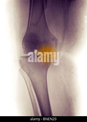 Ginocchio x-ray mostra comune malattia degenerativa Foto Stock