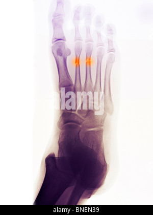 Piedi x-ray mostra fratturato di seconda e terza metatarsals Foto Stock