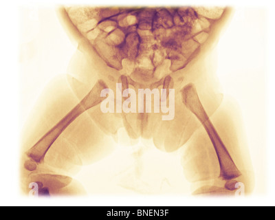 Bacino x-ray mostra lo sviluppo di ossa Foto Stock