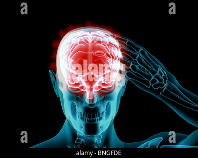 Vista ai raggi X di un uomo afferrando il suo cranio nel dolore Foto Stock