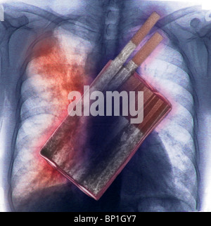 Illustrazione di un esame a raggi x di un pacchetto di sigarette sovrapposti su una radiografia del torace che mostra il cancro del polmone. Foto Stock