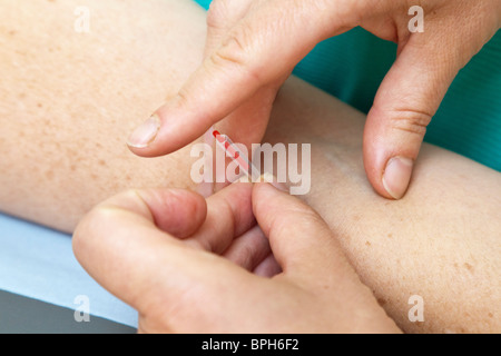 Aghi di agopuntura in un paziente Foto Stock