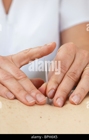 L'inserimento di aghi di agopuntura in un paziente Foto Stock