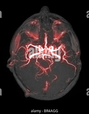 Angiogramma di 34 anno vecchio maschio, che mostra un normale circolo di Willis, arterie alla base del cervello Foto Stock