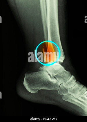 Raggi X che mostra un bimalleolar caviglia frattura in un anno 50 vecchia donna Foto Stock