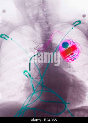 I raggi x al torace di un 80 anno vecchio che mostra il monitoraggio cardiaco, conduce un pacemaker al petto e fili chirurgico dalla cardiochirurgia Foto Stock
