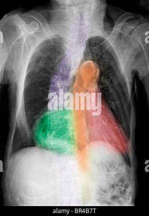 I raggi x al torace di 96 anno vecchia donna con calcificazioni dell'aorta, scoliosi e cambiamenti degenerativi Foto Stock