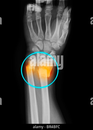 Distale di radio e ulna frattura con spostamento Foto Stock